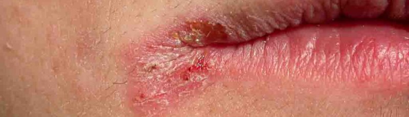 الجلفة - Dermatologie, Maladies de la peau