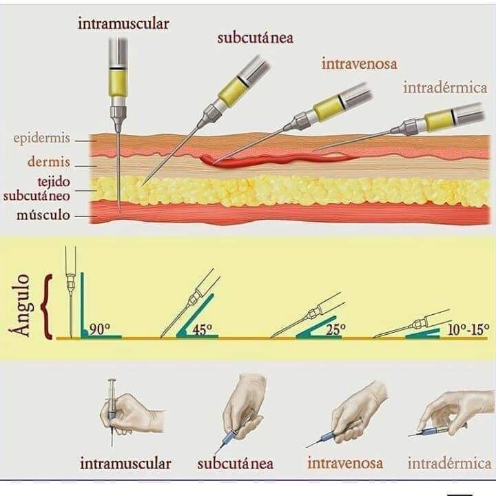 les angles d injection pour chaque type sous cutané intradermique